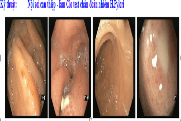 MỘT TRƯỜNG HỢP ABSCESS VÙNG HANG VỊ- CĂN BỆNH HIẾM GẶP- ĐƯỢC ĐIỀU TRỊ THÀNH CÔNG TẠI BỆNH VIỆN TÂM TRÍ CAO LÃNH