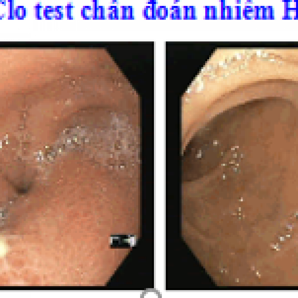 MỘT TRƯỜNG HỢP ABSCESS VÙNG HANG VỊ- CĂN BỆNH HIẾM GẶP- ĐƯỢC ĐIỀU TRỊ THÀNH CÔNG TẠI BỆNH VIỆN TÂM TRÍ CAO LÃNH