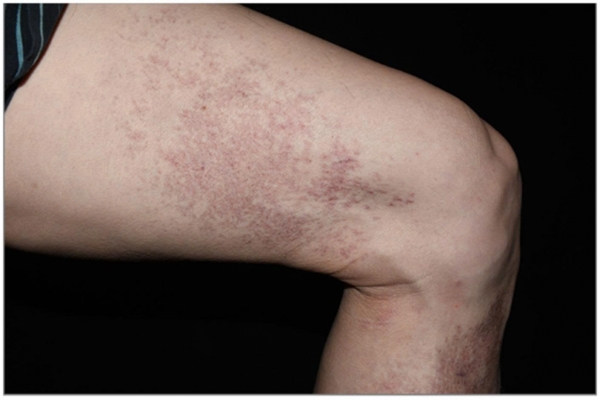 Identifying Collagen Vascular Disease Through Persistent Skin Lesions