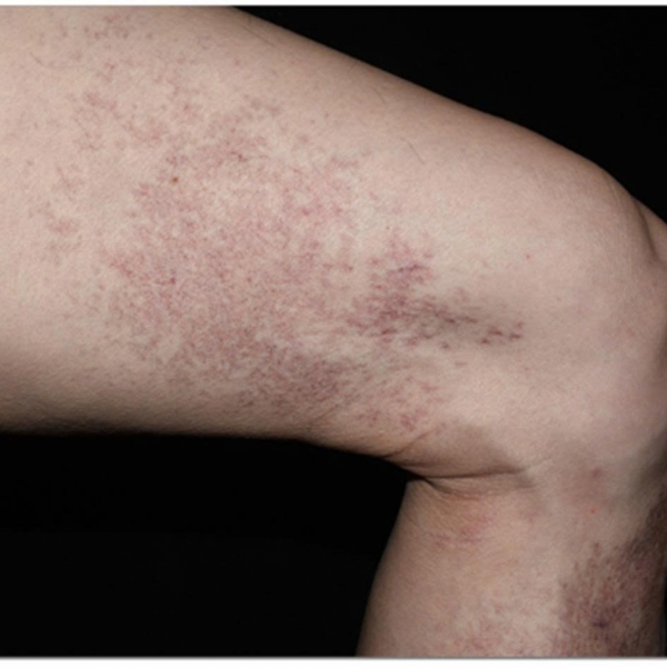 Identifying Collagen Vascular Disease Through Persistent Skin Lesions