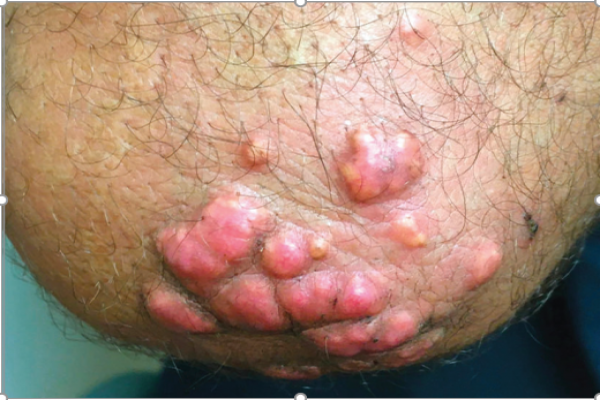 Chronic Progressive Pink-Yellow Papules and Nodules in a Middle-Aged Man