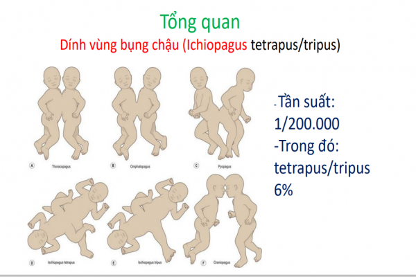 KẾT QUẢ TẠO HÌNH TIẾT NIỆU  SINH DỤC TRONG PHẪU THUẬT  CA SONG NHI DÍNH VÙNG  BỤNG CHẬU