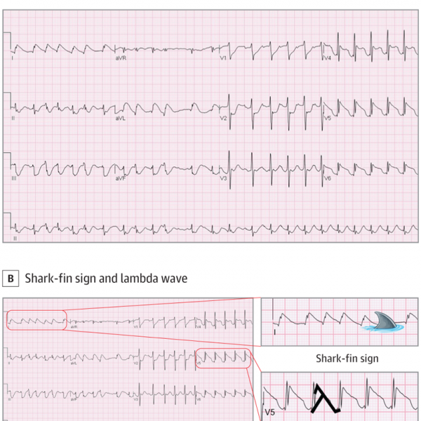 ST-Segment Elevation in a Woman With Out-of-Hospital Cardiac Arrest