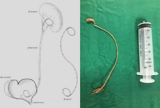 Mục đích đặt sonde JJ