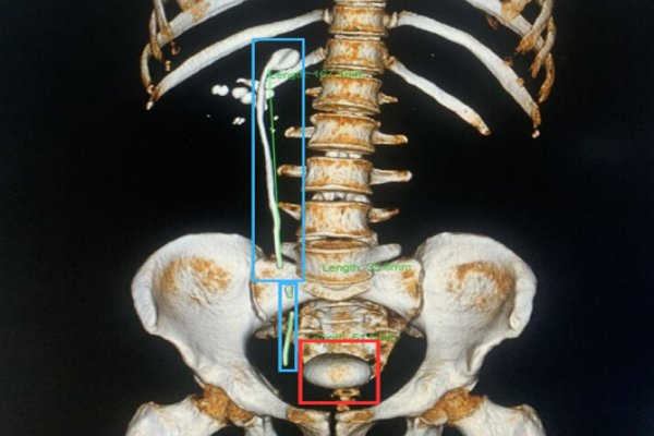 BÁO CÁO CASE LÂM SÀNG SỎI TIẾT NIỆU DO ỐNG THÔNG JJ BỊ BỎ QUÊN