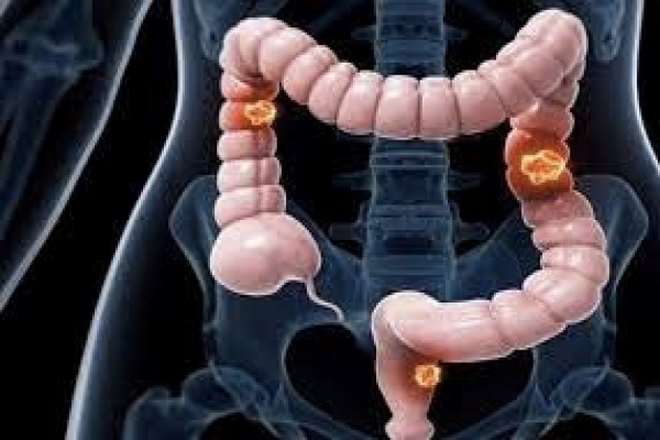 6 ways to limit your risk of colorectal cancer