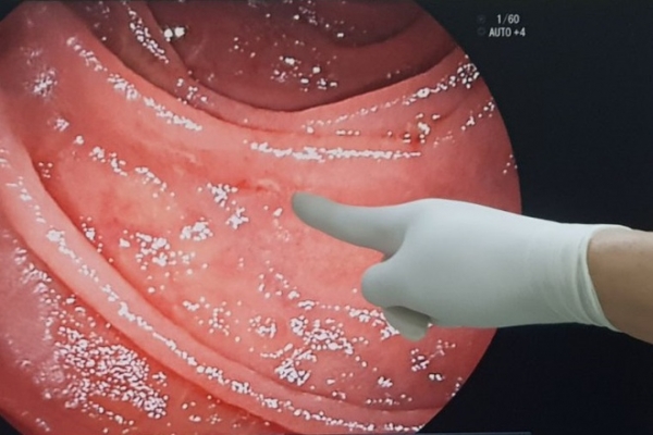 The doctor discovered 20 worms were sucking blood in the patient's intestines