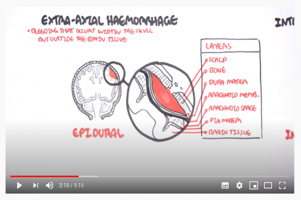 Intracranial Haemorrhage Types, signs and symptoms