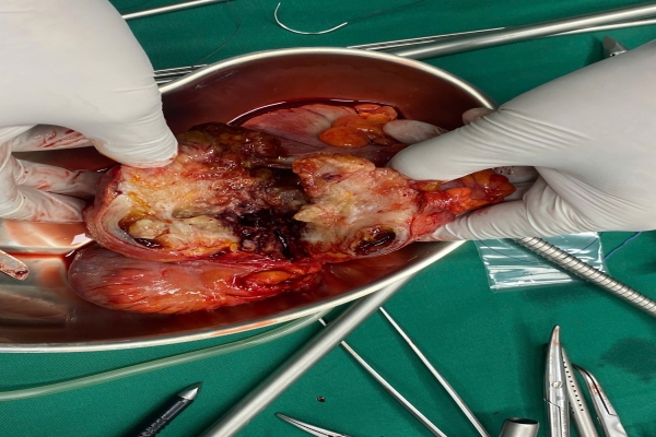 A large appendiceal mucinous tumor was detected in a 51-year-old patient