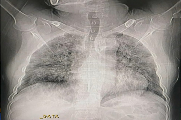 Pictures of human lungs with Covid-19 in Vietnam